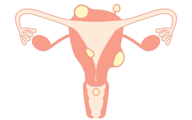 Ilustración diagramática de los fibromas uterinos anatomía del útero y los ovarios