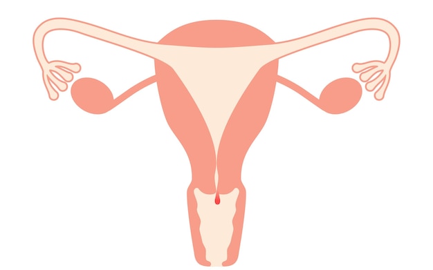 Vector ilustración diagramática de pólipos cervicales anatomía del útero y los ovarios
