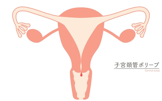 Ilustración diagramática de pólipos cervicales anatomía del útero y los ovarios