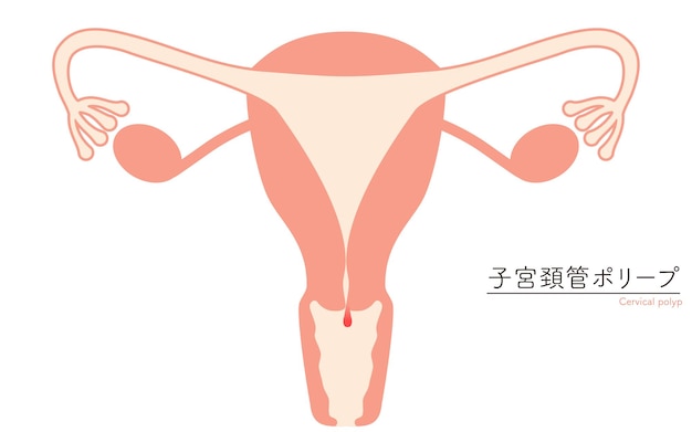 Vector ilustración diagramática de pólipos cervicales anatomía del útero y los ovarios