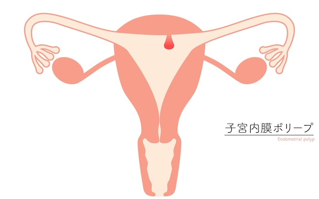 Vector ilustración diagramática de los pólipos endometriales anatomía del útero y los ovarios