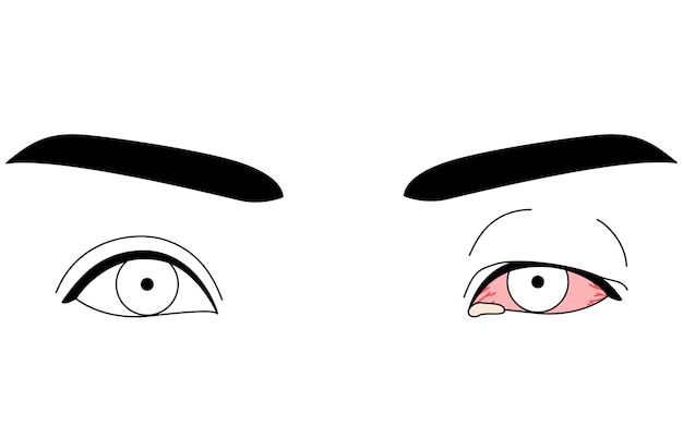 Ilustración de dibujo de línea de imágenes prediseñadas médicas de enfermedad ocular y conjuntivitis viral