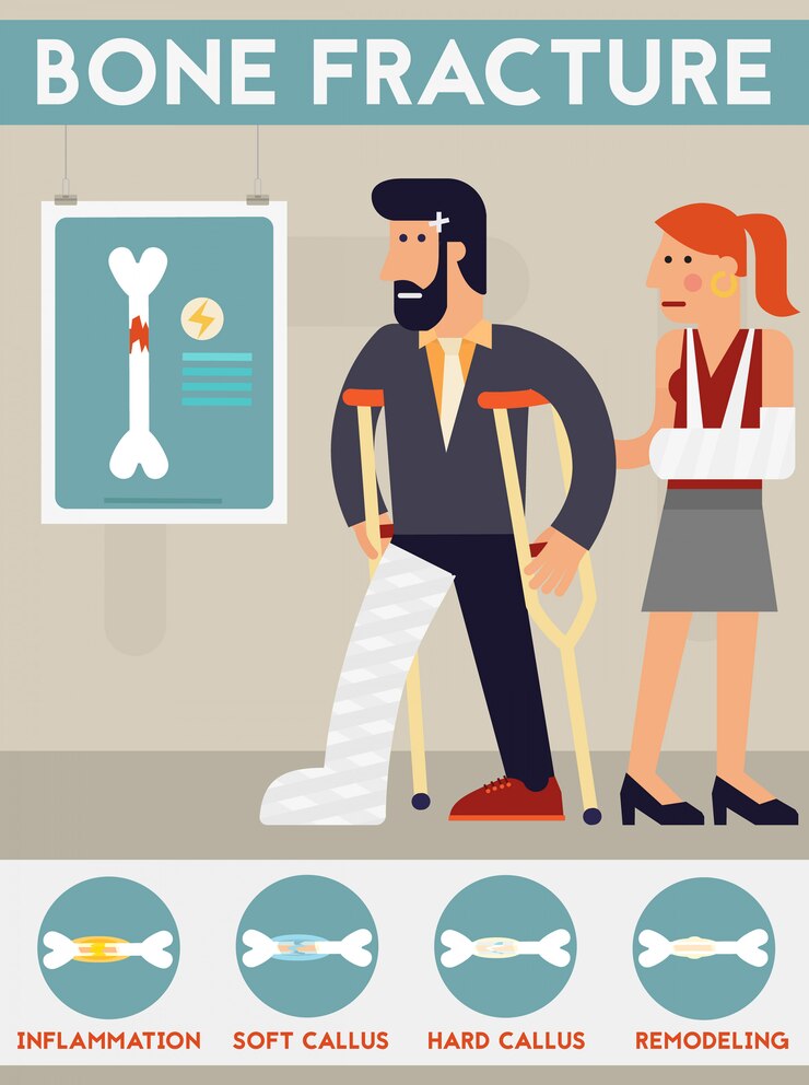 Vector ilustración de dibujos animados de personaje de vector de fractura ósea