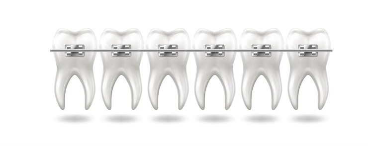 Vector ilustración de dientes con aparatos dentales