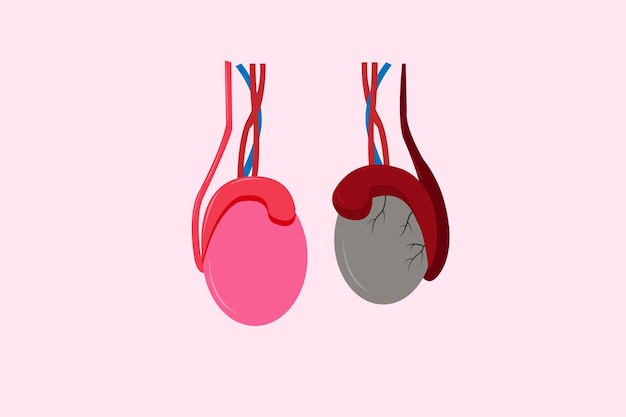 Vector ilustración de epididimitis inflamasi epididimis la epididimitis es la inflamación del epidídimo