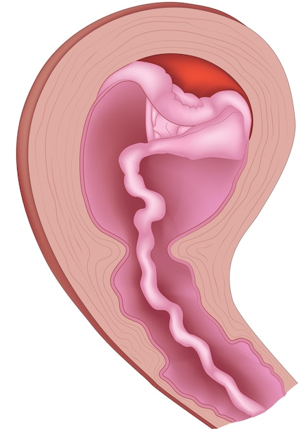 Una ilustración de un estómago humano con un intestino grueso.