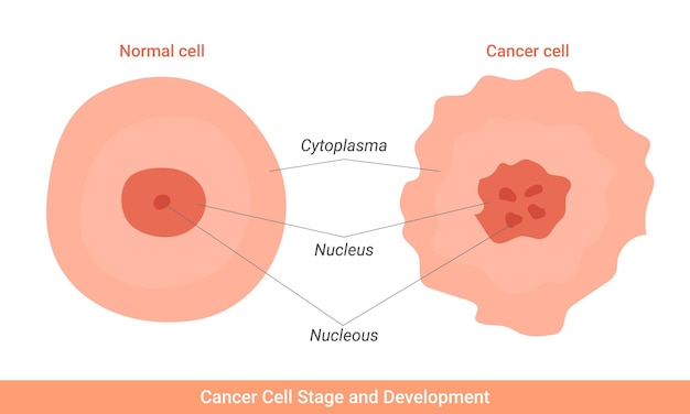 Ilustración de la etapa y el desarrollo de las células cancerosas