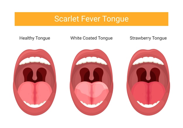 Vector ilustración de la etapa de la lengua de la fiebre del dengue