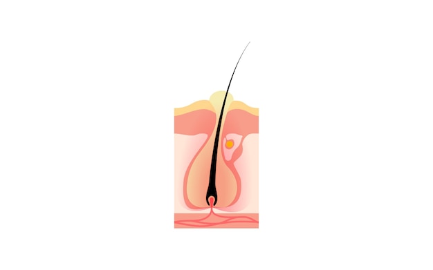 Ilustración de un furúnculo que empeora, una condición que empeora con la foliculitis y una espinilla