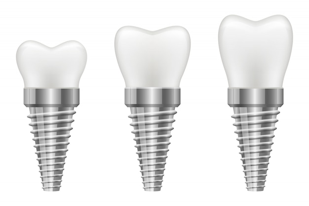 Ilustración de implante dental aislado sobre fondo blanco.