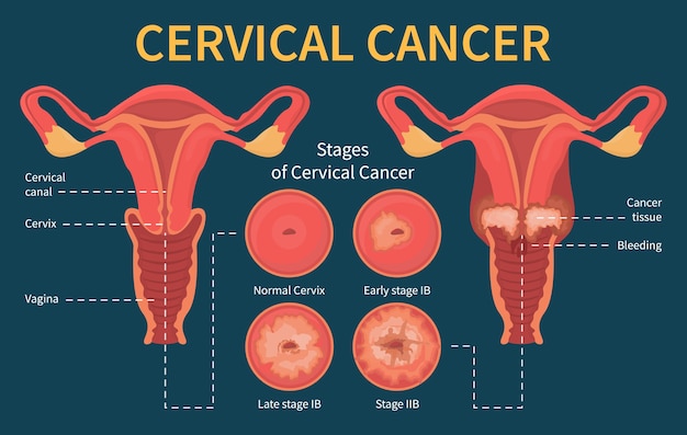 Ilustración de infografía de cáncer de cuello uterino