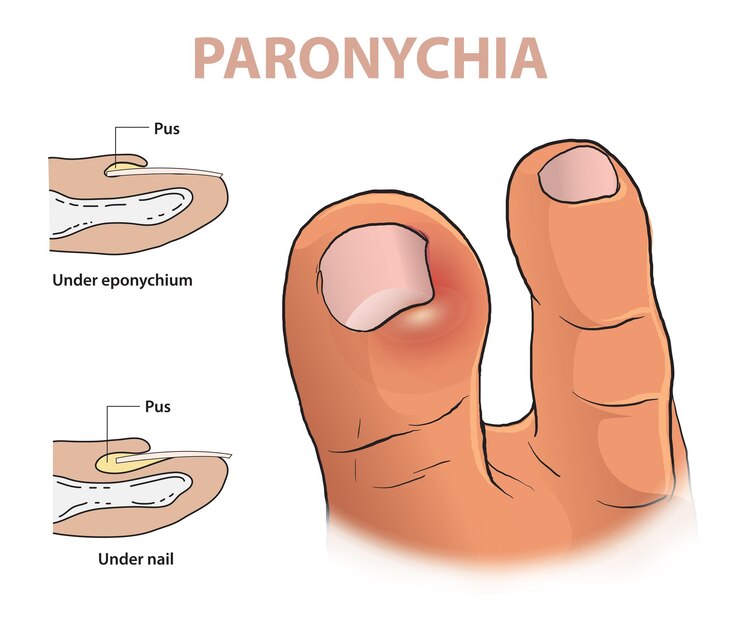 Vector ilustración infográfica de la infección por paroniquia en un dedo del pie