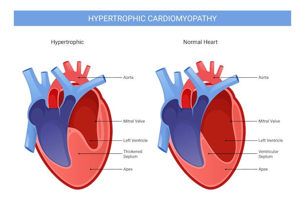 Vector ilustración infográfica de miocardiopatía hipertrófica