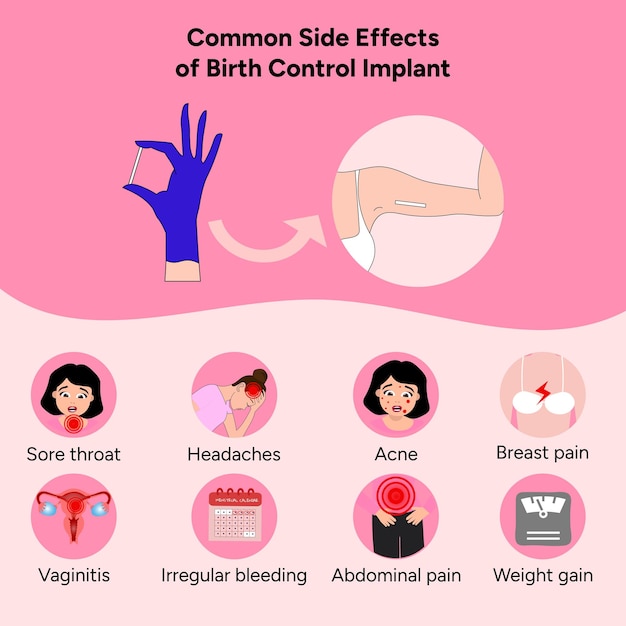 Ilustración de información sobre implantes anticonceptivos y efectos secundarios en vectores