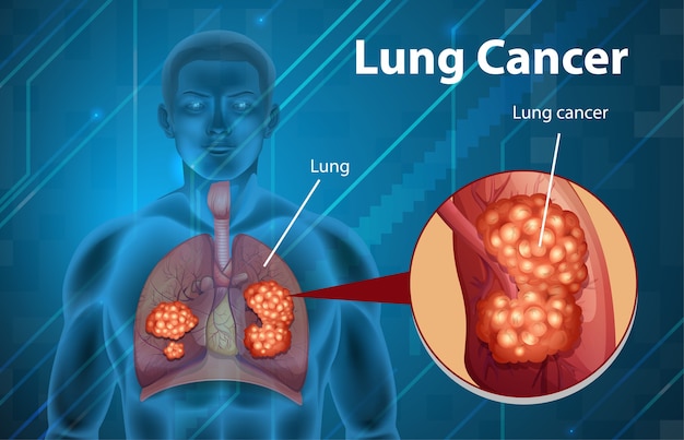 Ilustración informativa del cáncer de pulmón.