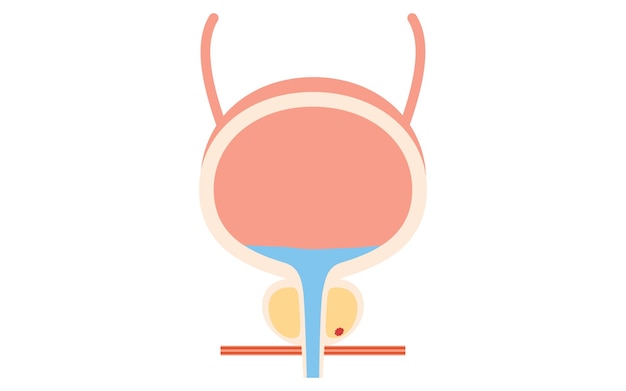 Ilustración médica del cáncer de próstata en la etapa 1