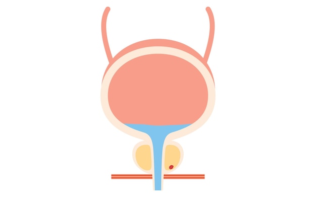 Vector ilustración médica del cáncer de próstata en la etapa 1