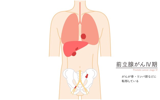 Vector ilustración médica del cáncer de próstata en la etapa 4