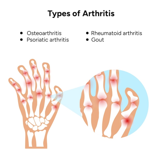 Vector ilustración médica e información sobre los tipos de artritis