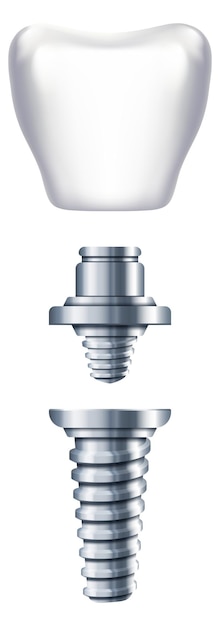 Vector ilustración de las partes del implante prótesis dentales esquema de ortodoncia