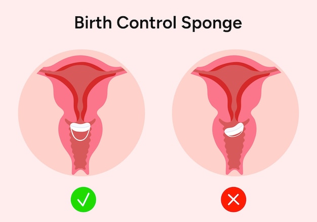 Ilustración de la posición de la esponja anticonceptiva en vector