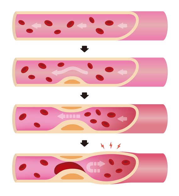 Vector ilustración de la progresión de la arteriosclerosis