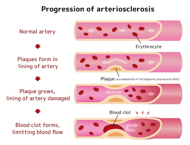 Vector ilustración de la progresión de la arteriosclerosis