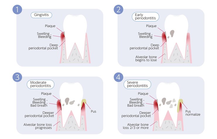 Vector ilustración de progresión de la enfermedad periodontal 4 etapas