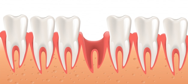 Vector ilustración realista de la cirugía dental en 3d vector