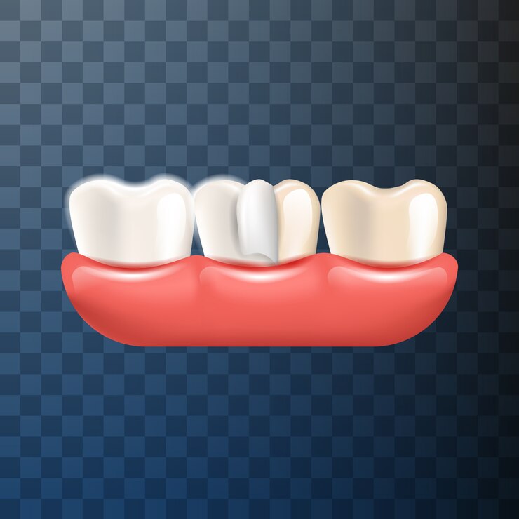 Vector ilustración realista corona dental en 3d vector