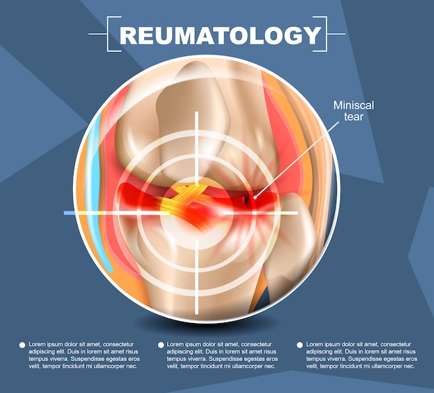 Ilustración realista reumatología medicina en 3d.