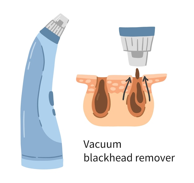 Vector ilustración de removedor de espinillas al vacío con capas de dermis y poros