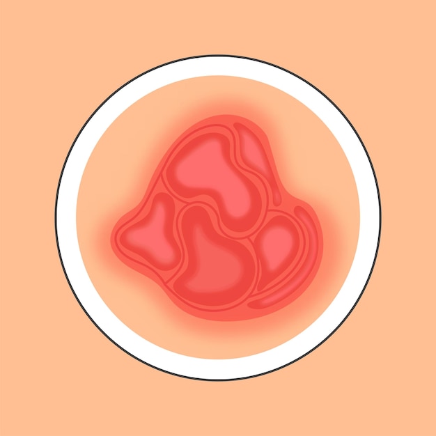 Vector ilustración de rojo y melocotón del icono del círculo de la enfermedad de la piel de la psoriasis