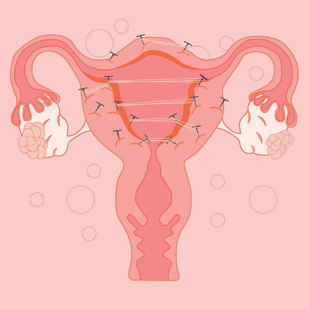 Una ilustración rosa de un útero con las uñas en el medio.