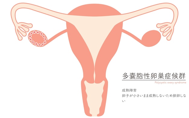 Vector ilustración del síndrome de ovario poliquístico trastorno de maduración anatomía del útero y los ovarios