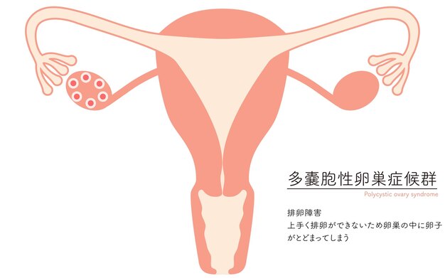 Vector ilustración del síndrome de ovario poliquístico trastorno de la ovulación anatomía del útero y los ovarios