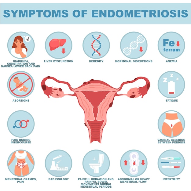 Vector ilustración de los síntomas del vector de la enfermedad reproductiva de la endometriosis