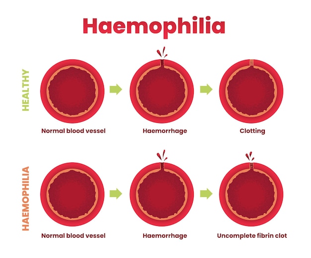 Ilustración de vaso sanguíneo sano de hemofilia frente a infografía de hemofilia