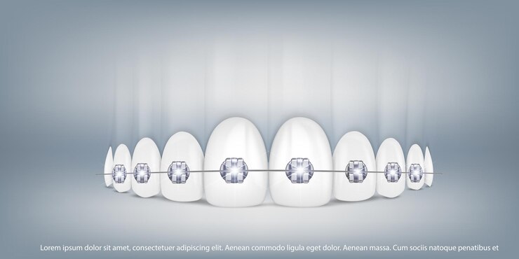 Vector ilustración de vector 3d dientes realistas con aparatos ortopédicos en la mandíbula superior e inferior