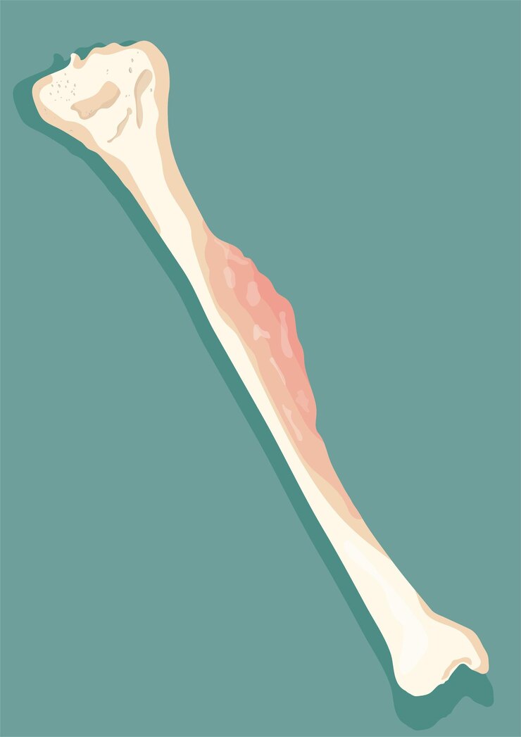 Vector ilustración de vector de cáncer de hueso