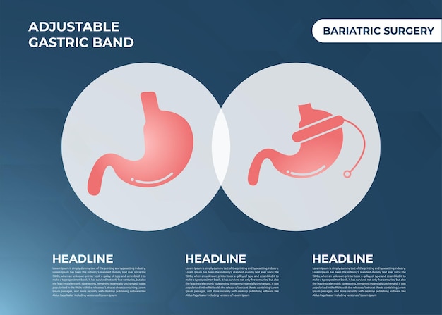 Ilustración del vector de cirugía de pérdida de peso del dispositivo de banda gástrica ajustable