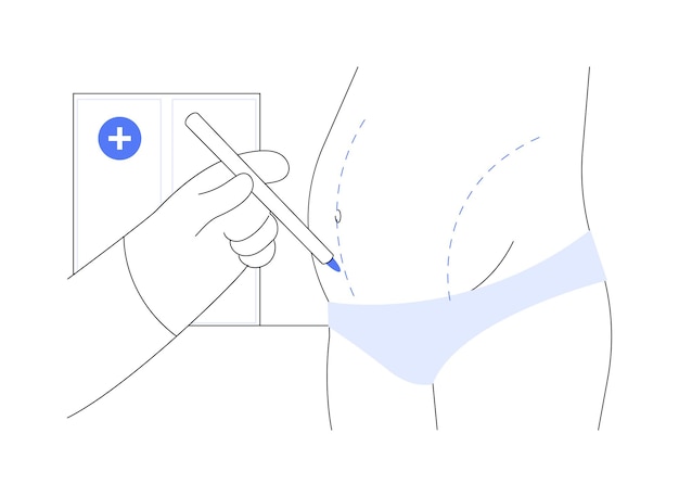 Vector ilustración de vector de concepto abstracto de abdominoplastia