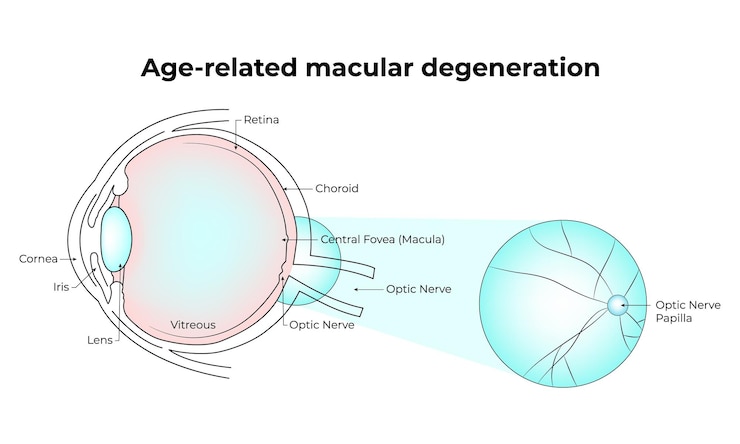 Vector ilustración del vector de la degeneración macular relacionada con la edad retina coroide nervio óptico lente vítrea