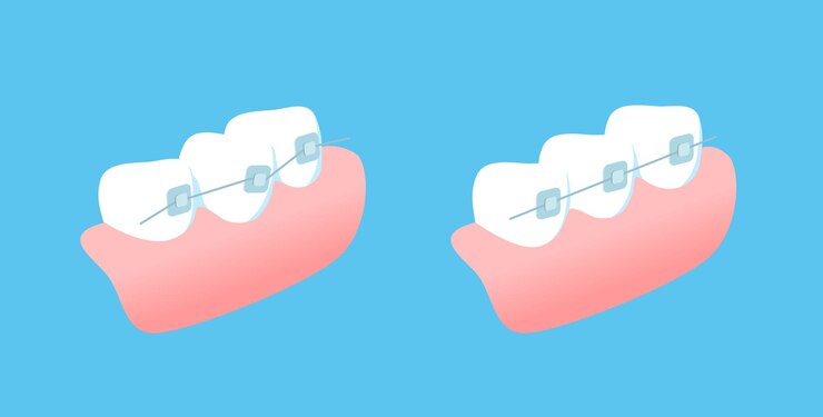 Ilustración de vector de dientes y encías de ortodoncia sobre fondo azul