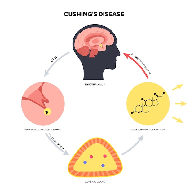 Ilustración del vector de la enfermedad del síndrome de Cushing Cortisol en la glándula suprarrenal Aumento de la secreción de ACTH
