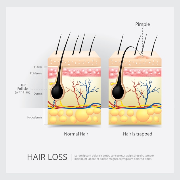 Ilustración de vector de estructura de pérdida de cabello