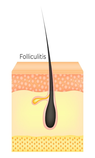 Vector ilustración del vector de la foliculitis capilar humana