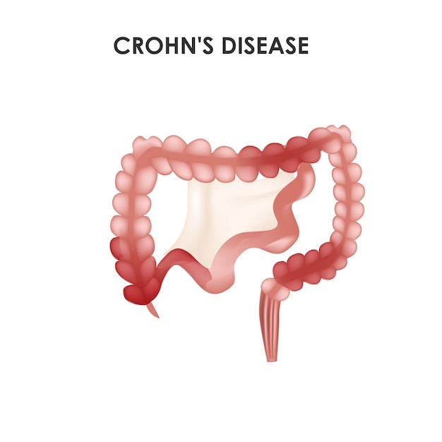 Ilustración de vector médico de la enfermedad de Crohn