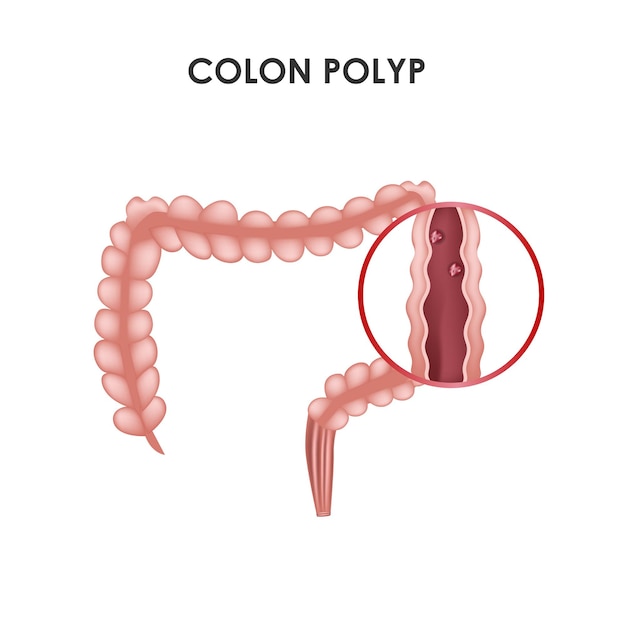 Ilustración de vector médico de pólipo de colon