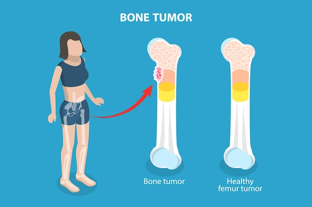 Ilustración de vector plano isométrico 3D de un tumor óseo